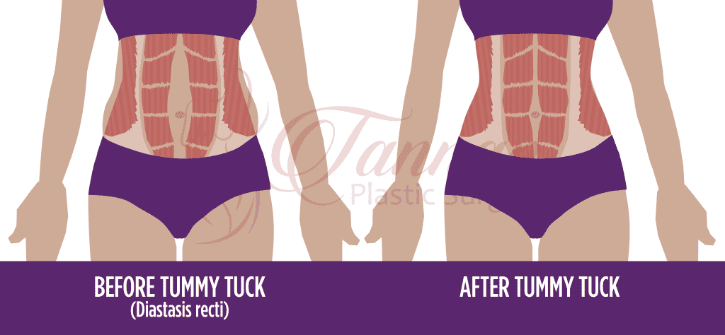 does insurance cover a tummy tuck after c-section