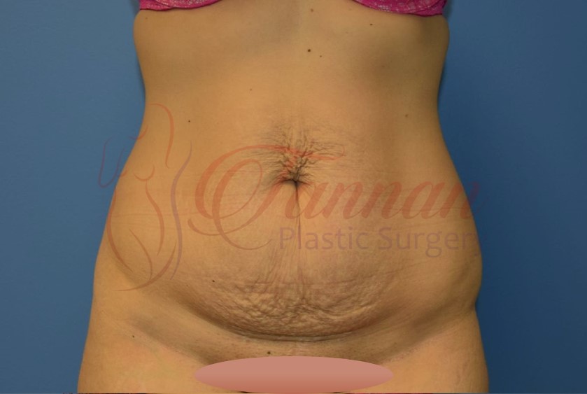 Tummy Tuck 1a BEFORE - Tannan Plastic Surgery