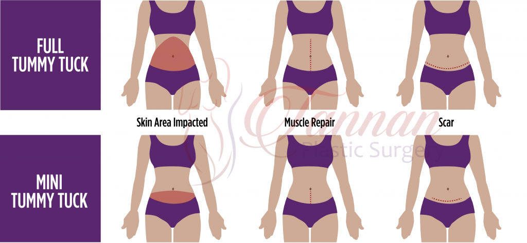 Tummy Tuck Recovery Timeline