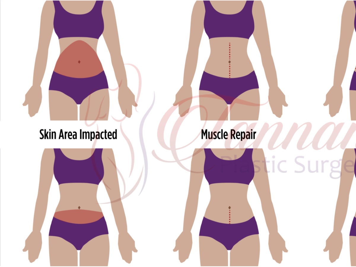 Signs of a Great Tummy Tuck