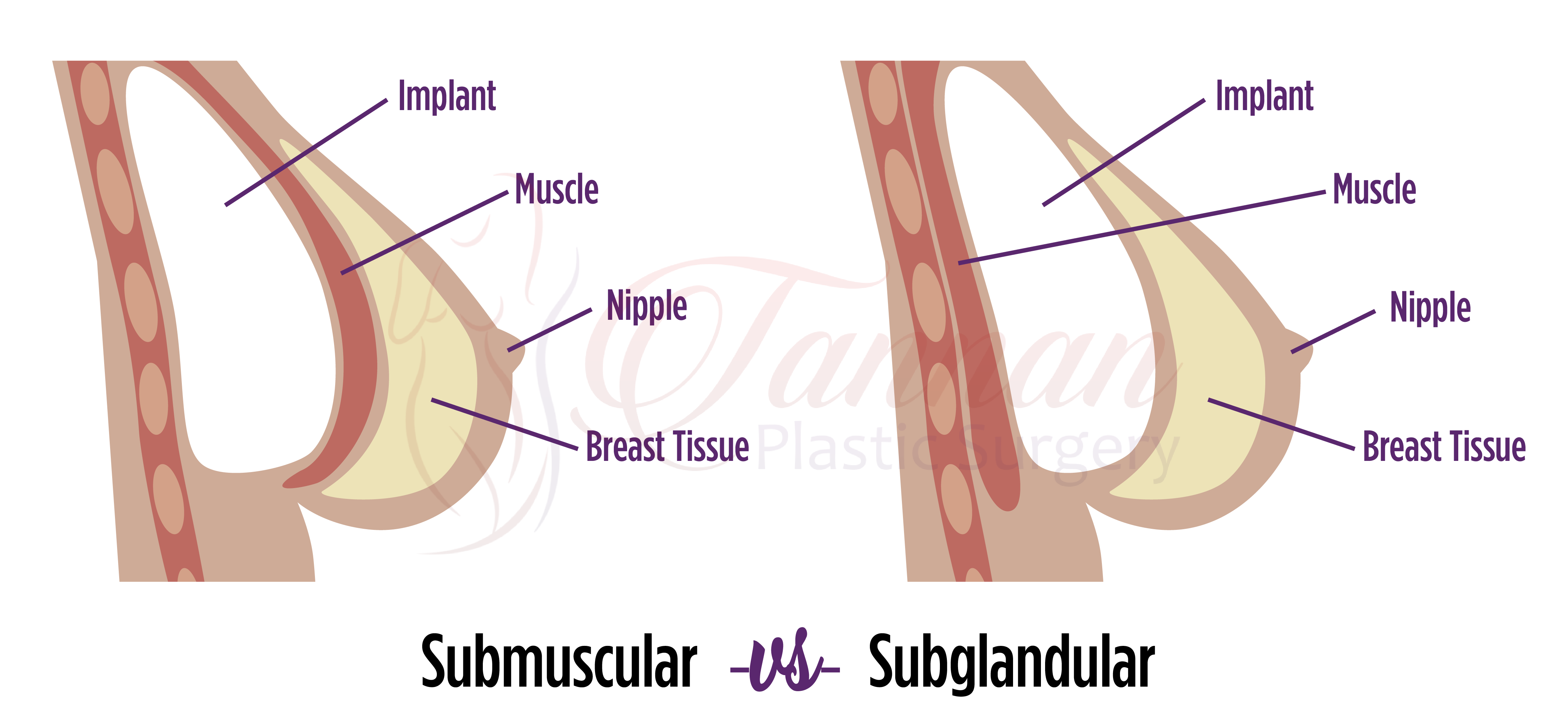 Breast Augmentation - Tannan Plastic Surgery
