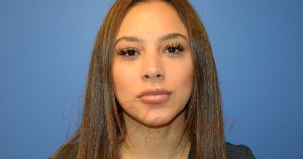 virginia-lip-filler-after-front - Tannan Plastic Surgery ...