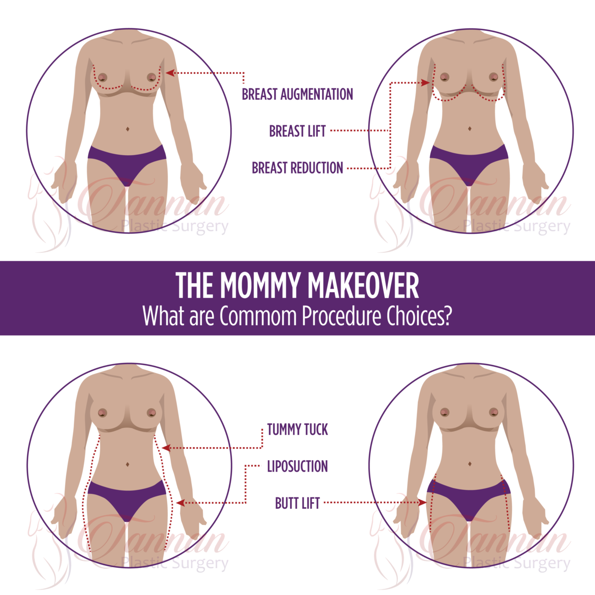 My mommy makeover patient 8 weeks post op after tummy tuck, and