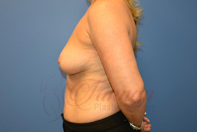 Breast-Augmentation-Before-0502-Tannan-Plastic-Surgery