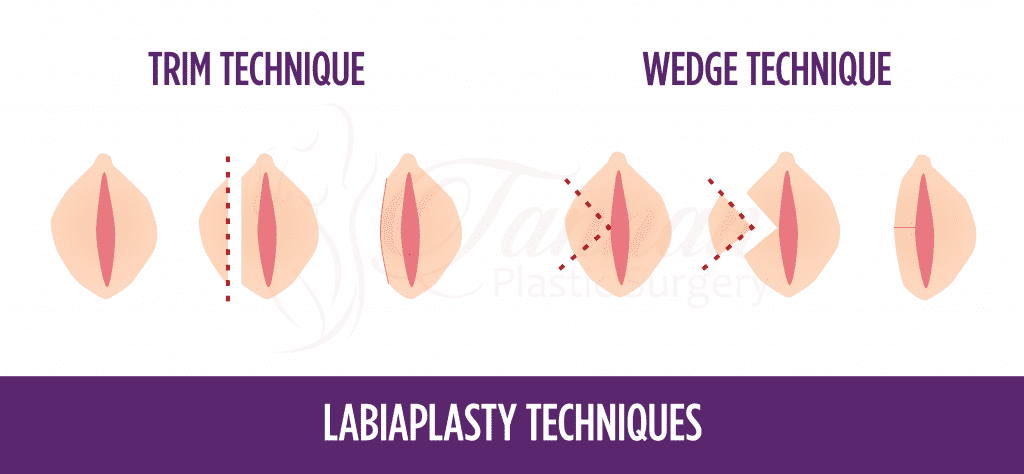 When Will Swelling Go Down After Labiaplasty Surgery?