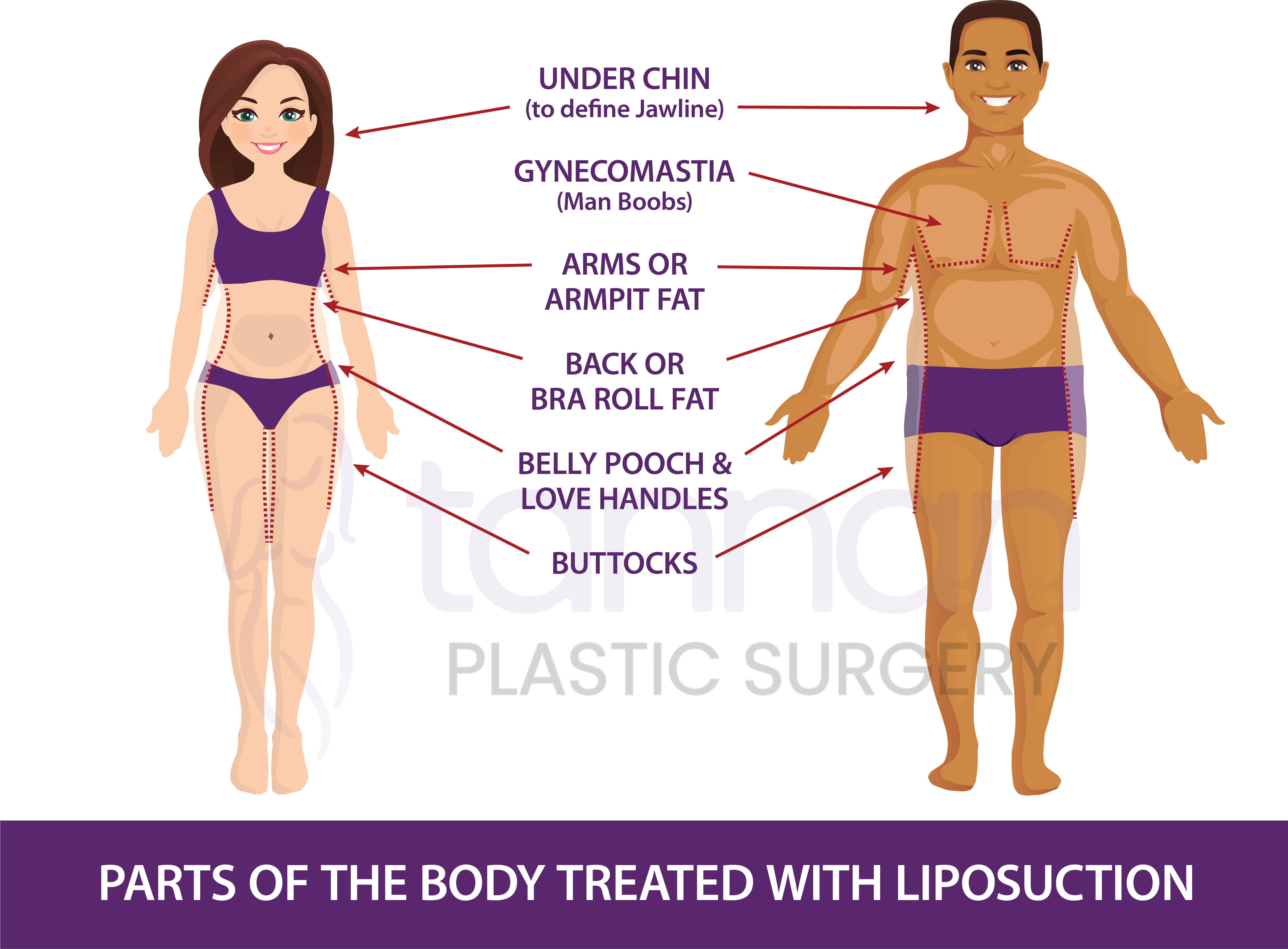 Which parts of the body can be treated with Liposuction