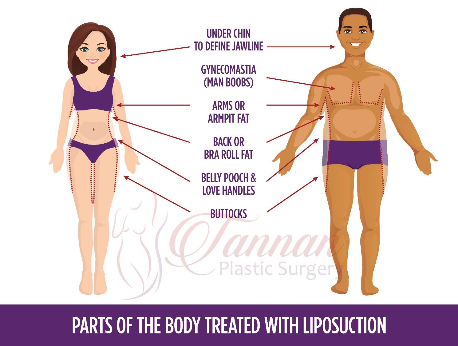 Which Parts of the Body Can Be Treated with Liposuction