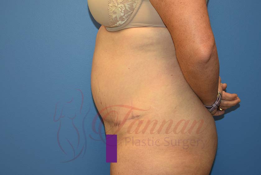Tummy Tuck Before and After - Tannan Plastic Surgery