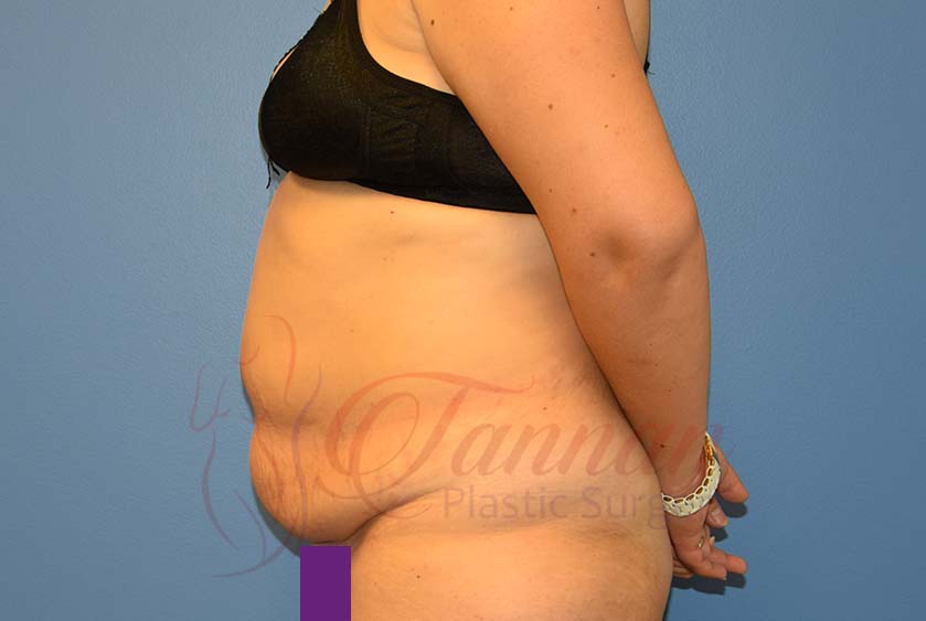 Tummy Tuck Before and After - Tannan Plastic Surgery