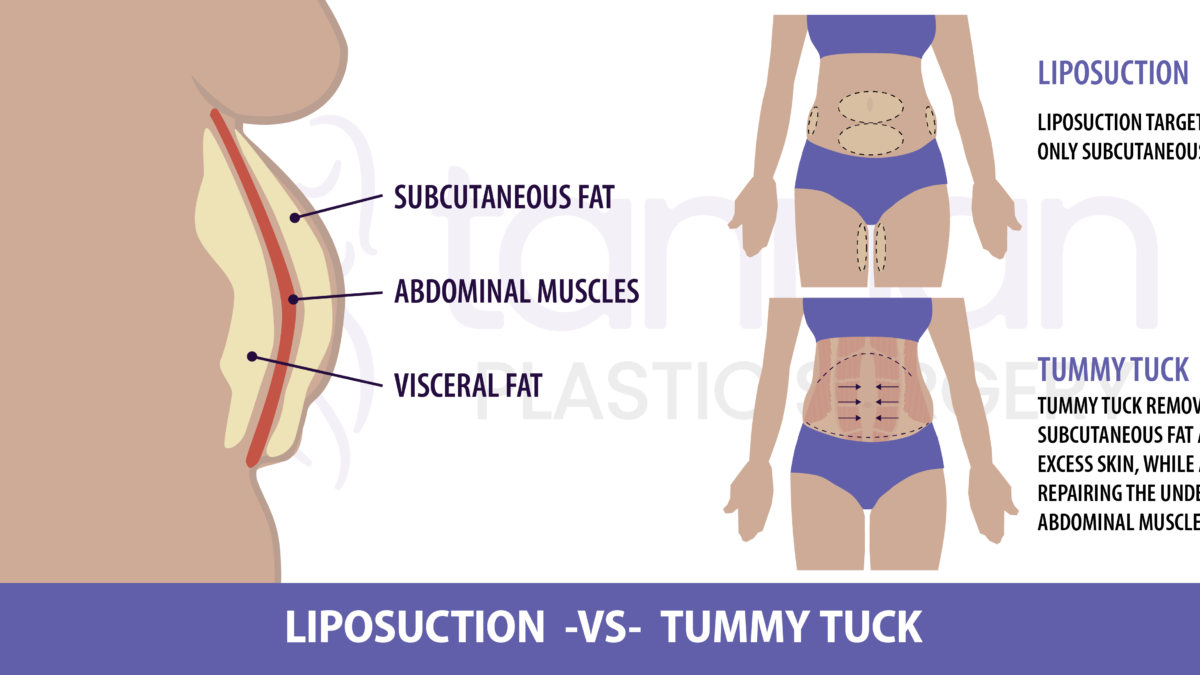 Is Laser Lipo Better Than a Tummy Tuck? - Tannan Plastic Surgery