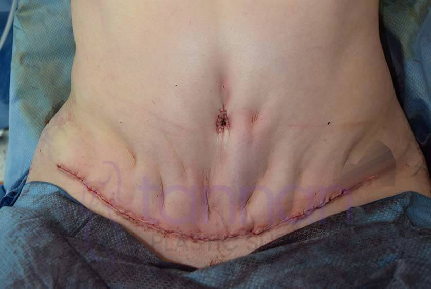 Dimples after drainless tummy tuck