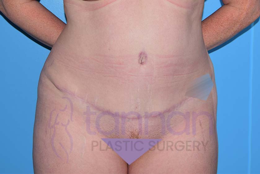 Front view after a drainless tummy tuck