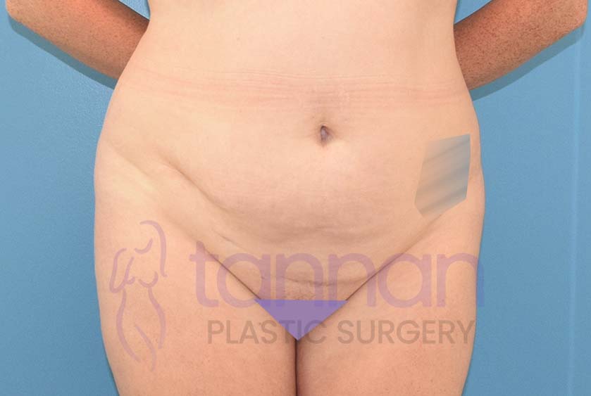 Front view before a drainless tummy tuck