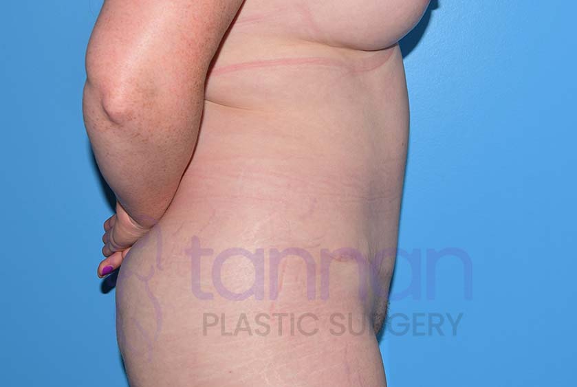 Side view after a drainless tummy tuck