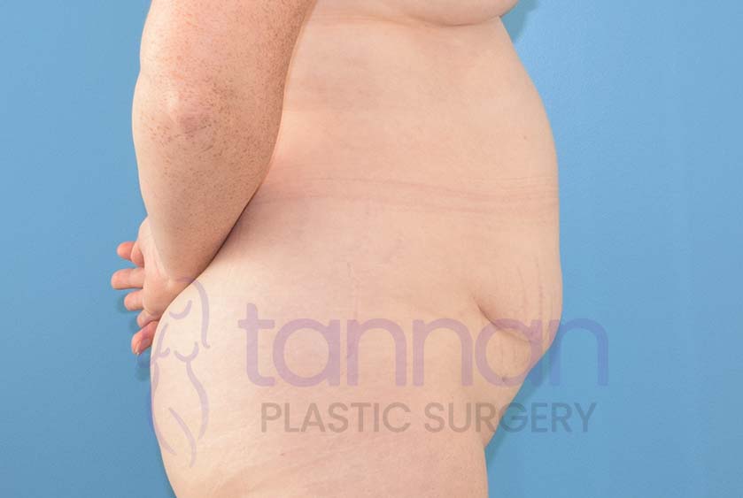 Side view before a drainless tummy tuck