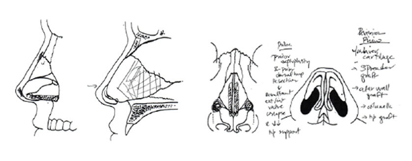 plastic surgeon's revision rhinoplasty worksheet